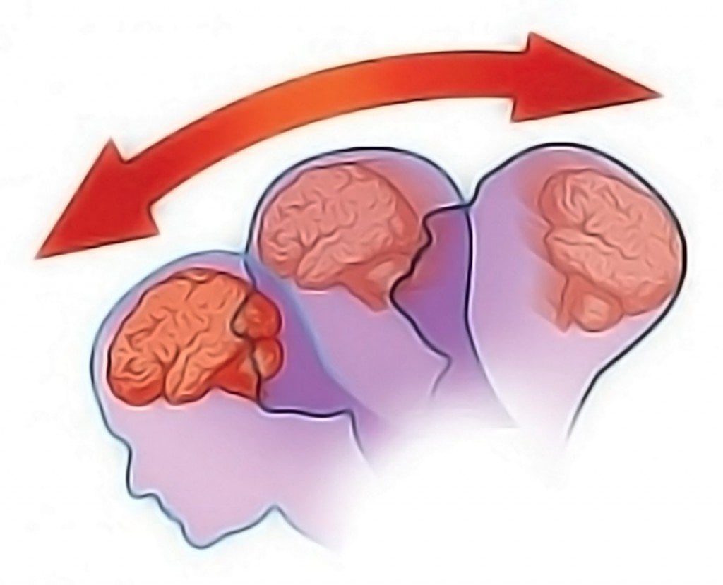 What happens to the body during a knockout What happens to the body during a knockout