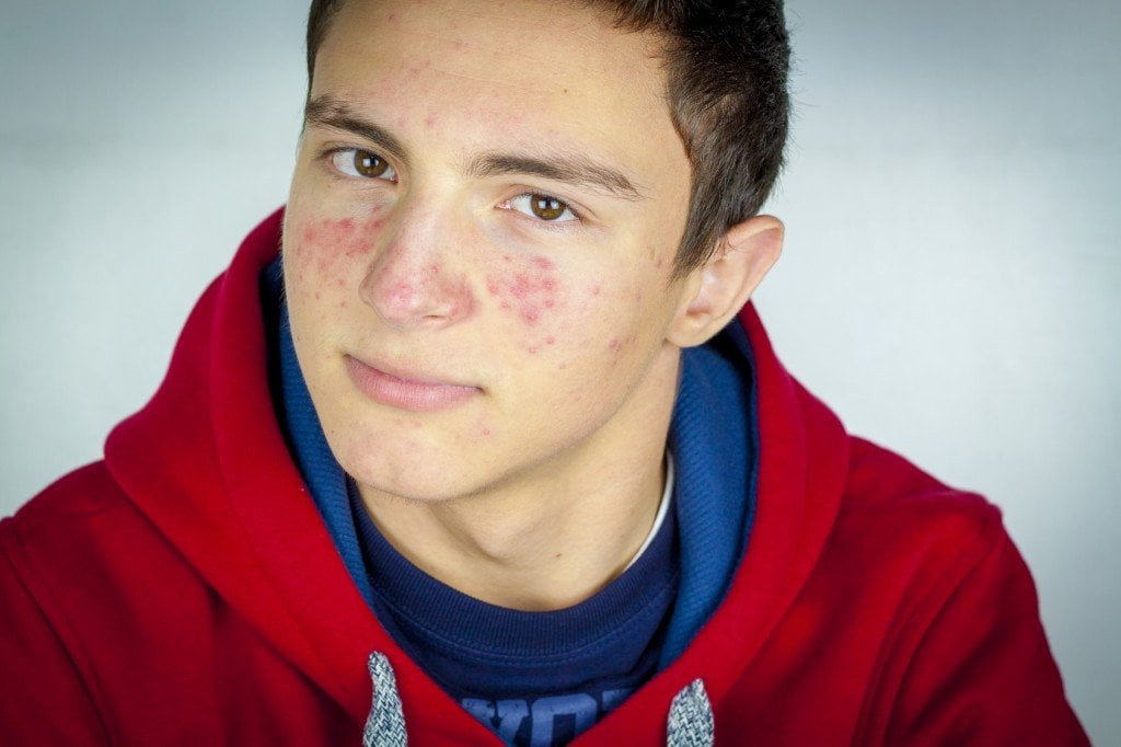 Menino com acne (Crédito da foto: hriana / Fotolia)
