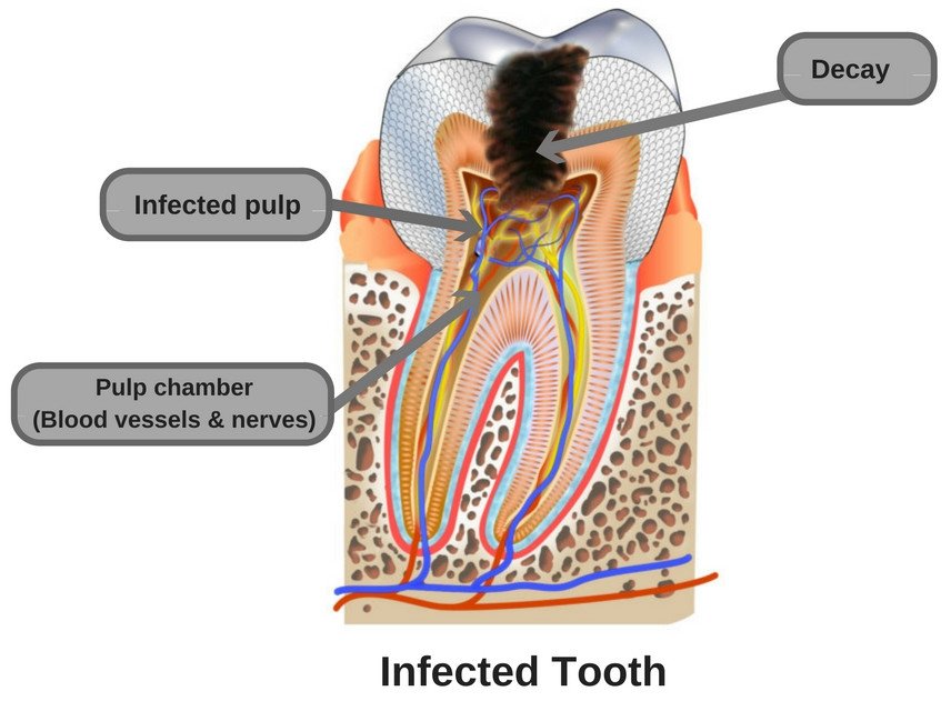 Infectado-dente-decadência