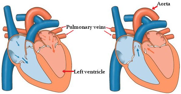 Orthopnea Definition Orthopneic Positions Symptoms Causes Treatment
