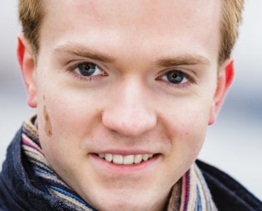 Birthmark on Young Handsome mans face model