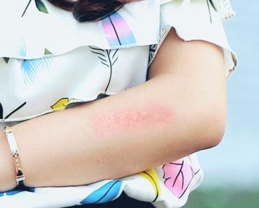 Woman hand on skin allergie