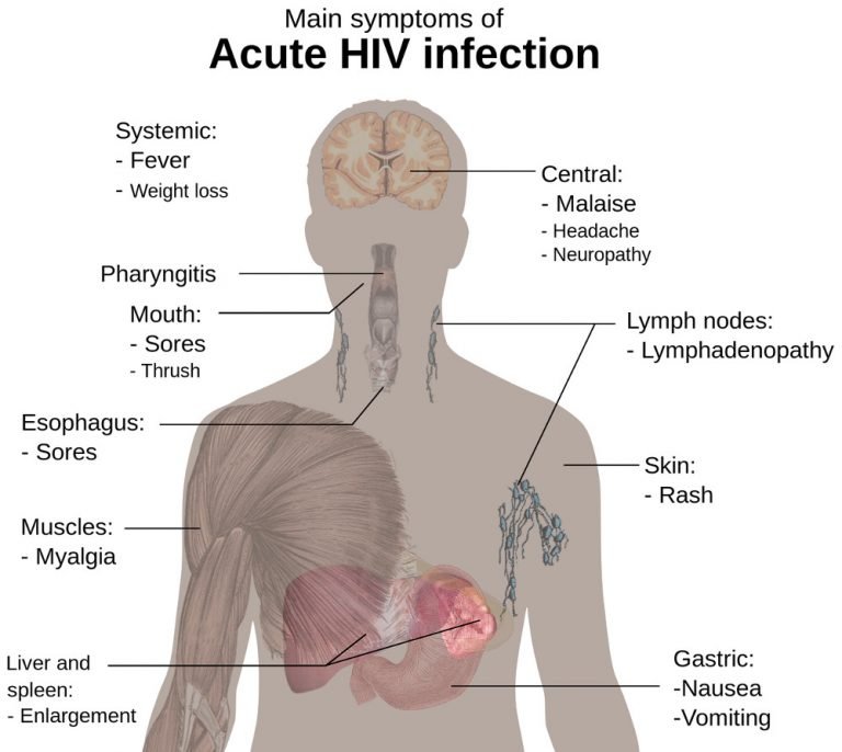 HIV Infection Causes, Symptoms, Stages of HIV Infection, Treatment