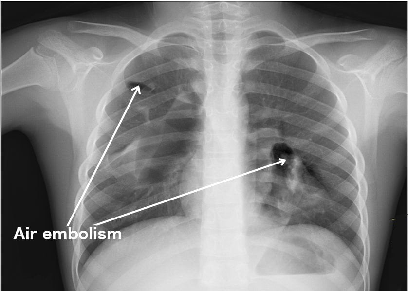 Embolism: Definition, Symptoms, Effects and Dangers