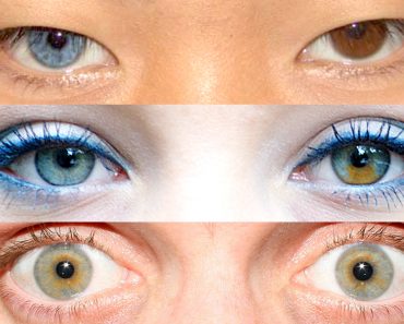 heterocromia