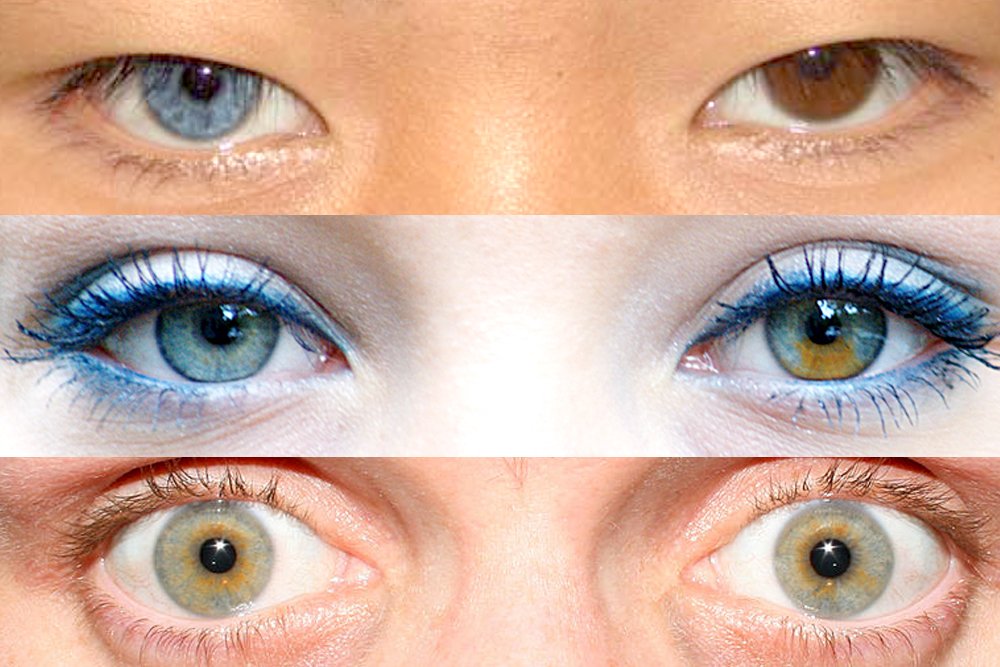 humans with two different colored eyes