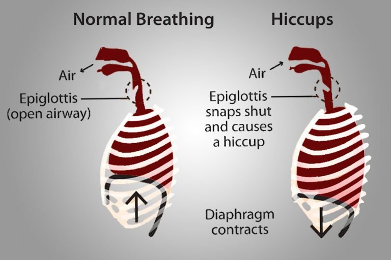 Drunk hiccups why does alcohol cause hiccups 