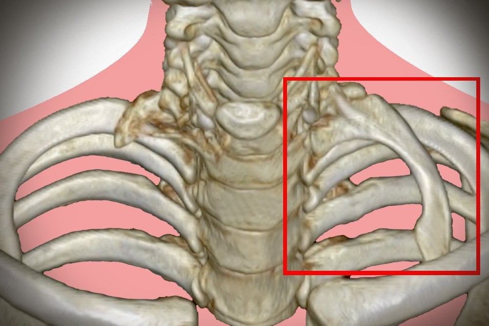 What Are Cervical Ribs? Are They Dangerous?