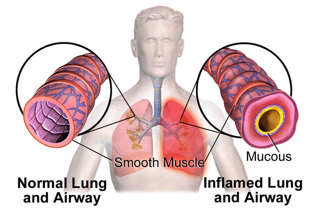 Pulmões Normal vs InflamedAirway