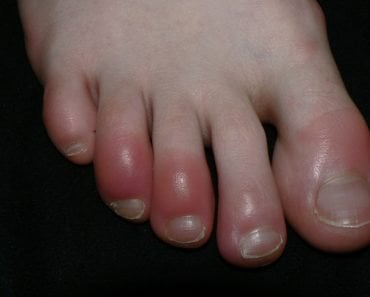 Acrocyanosis