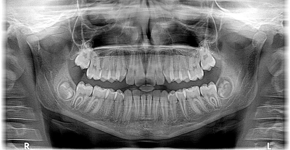 Foto de mandíbula de raio-x Roentgen dentes dentista