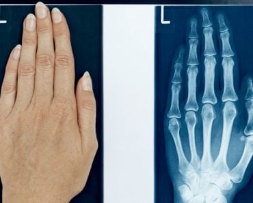 hand x ray