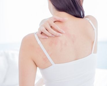 woman scratching her shoulder and neck because of dry skin at home(aslysun)s