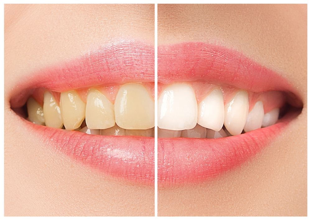 The female teeth before and after whitening(Master1305)s