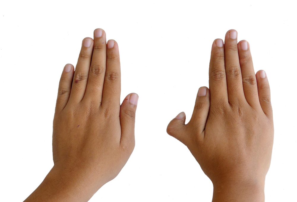 6 Fingers (Polydactylism): Why Are Some People Born With An Extra Digit?