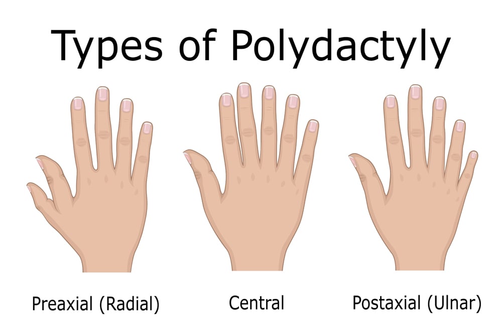 6 Fingers (Polydactylism) Why Are Some People Born With An Extra Digit?