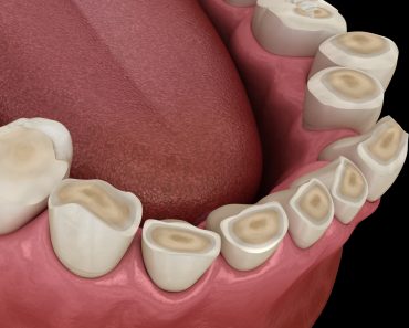 Dental,Attrition,(bruxism),Resulting,In,Loss,Of,Tooth,Tissue.,Medically