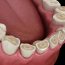Dental,Attrition,(bruxism),Resulting,In,Loss,Of,Tooth,Tissue.,Medically