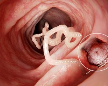 Tapeworm,In,Human,Intestine,,Magnification,Of,The,Head,Attached,To