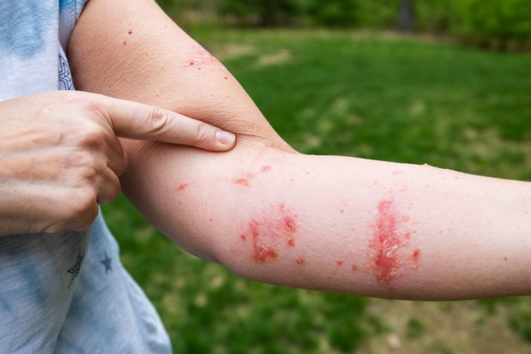 Why Does Poison Ivy Cause A Rash? » ScienceABC