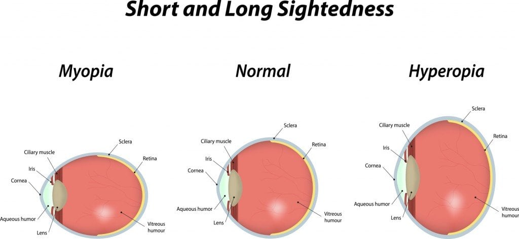 Hyperopia and Myopia (Photo Credit: joshya / Fotolia)