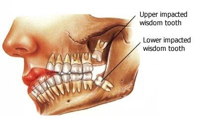 wisdomteeth1