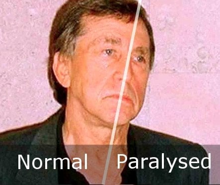 paralysis