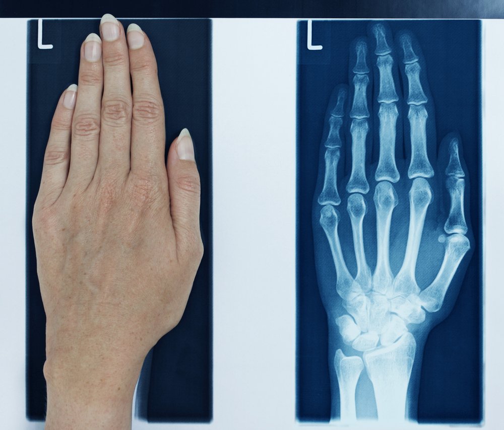 x-ray left hand