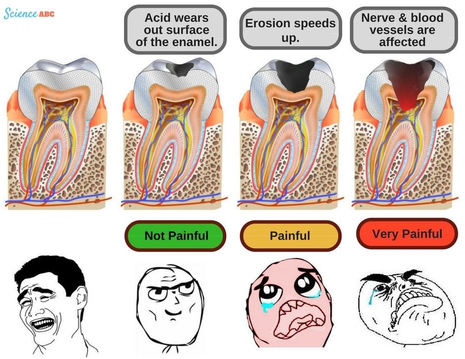 Stages of tooth decay