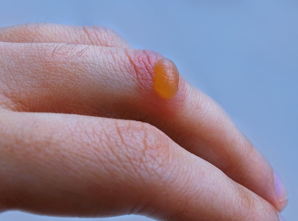A burn blister on the hand(Monika Zajac)s