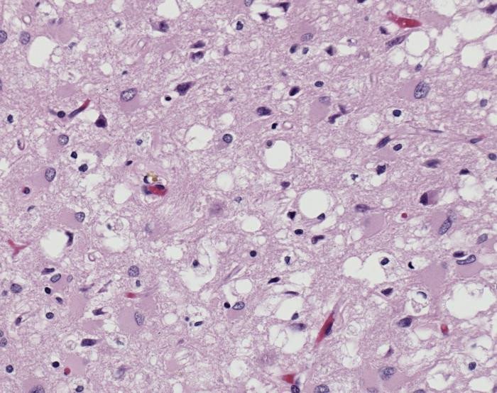 Variant Creutzfeldt-Jakob disease (vCJD), H&E