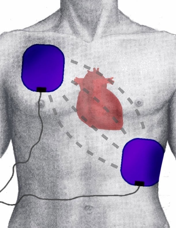 Position of Electrodes during Defibrillation-Kardioversion, Position of Heart, Flow of intrathrocical Energy during Shock.
