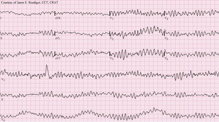 Ventricular fibrillation