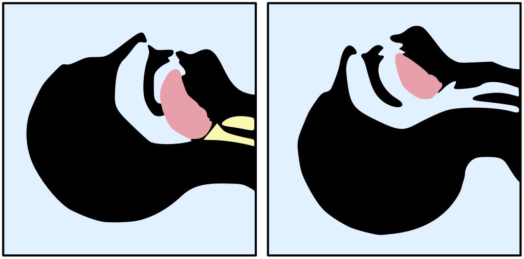 Tongue blocking airway