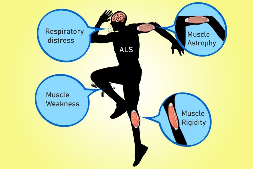 ALS symptoms