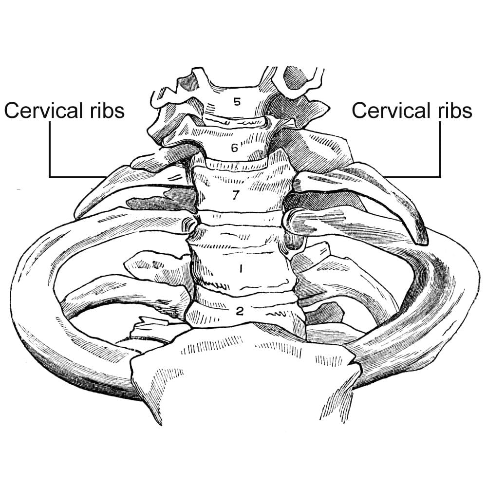 cervical ribs