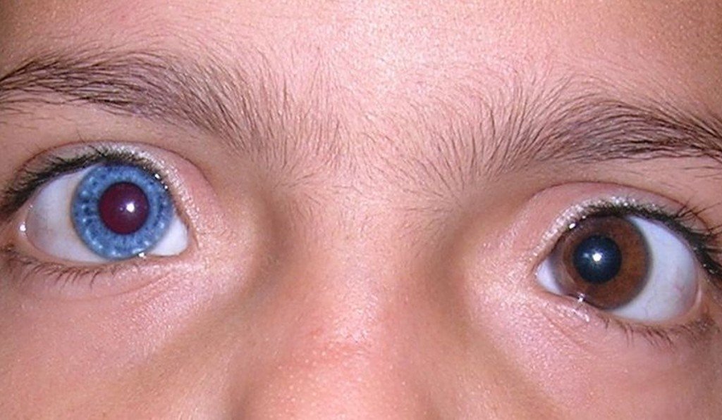 Meaning heterochromia