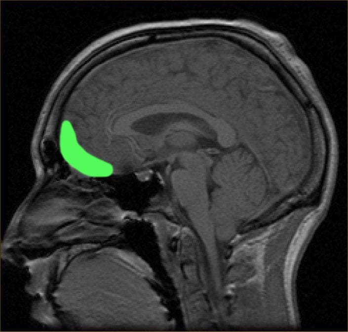 MRI_of_orbitofrontal_cortex