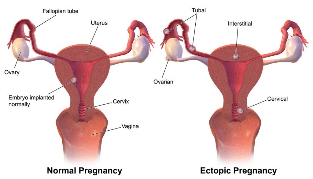 Ectopic_Pregnancy