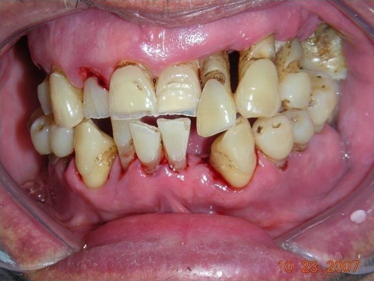 Periodontitis_Crónica_Severa