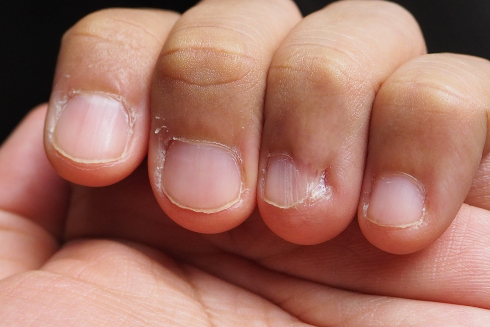 Closeup de dedos e unhas mordidas de um homem.  Conceito médico e de saúde - Image (topperspix) s