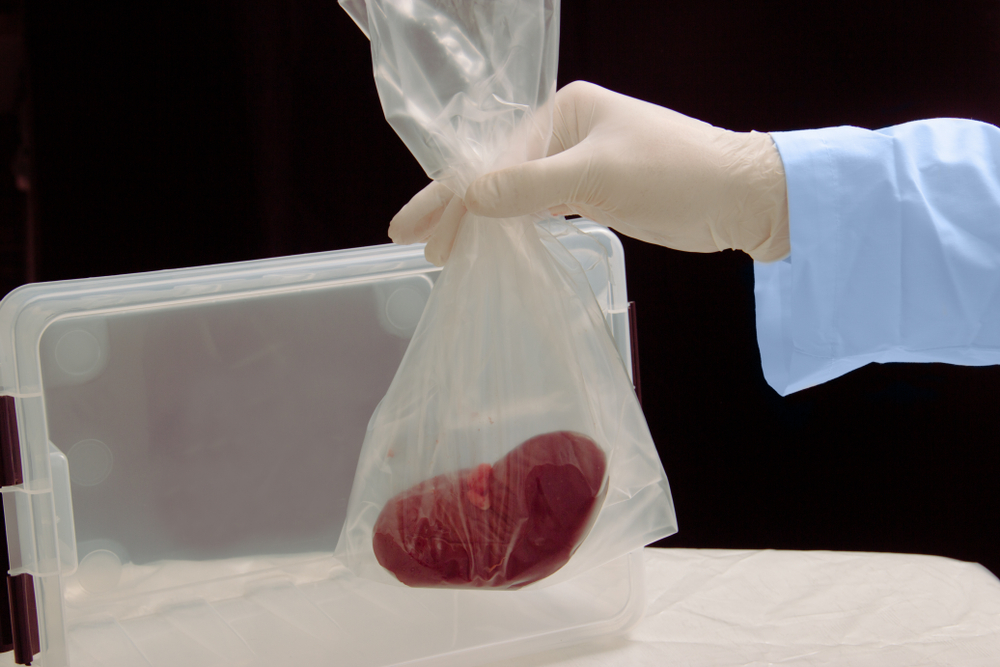 kidney transplant surgery. illegal transplantation. human cadaver, donor organ in hands of surgeon (Luuuusa)S