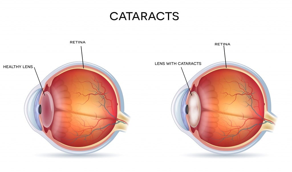 Cataracts and healthy eye detailed structure. - Vector(Tefi)s