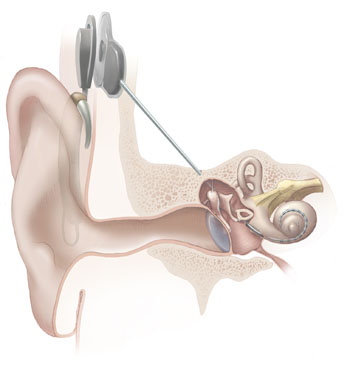 Cochlear implant