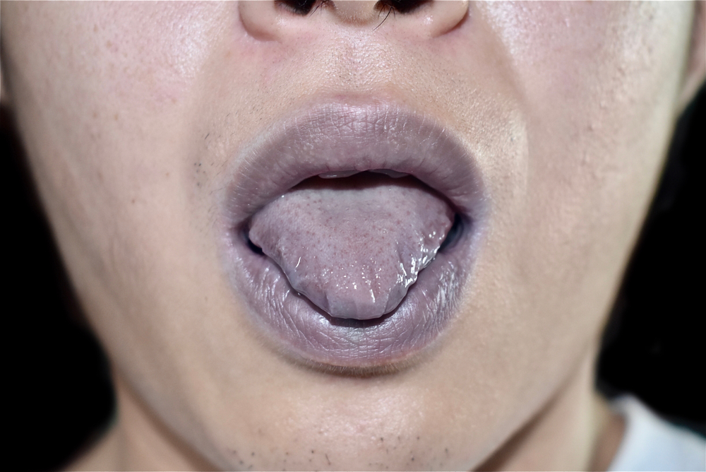 Cyanosis definition causes symptoms and treatment