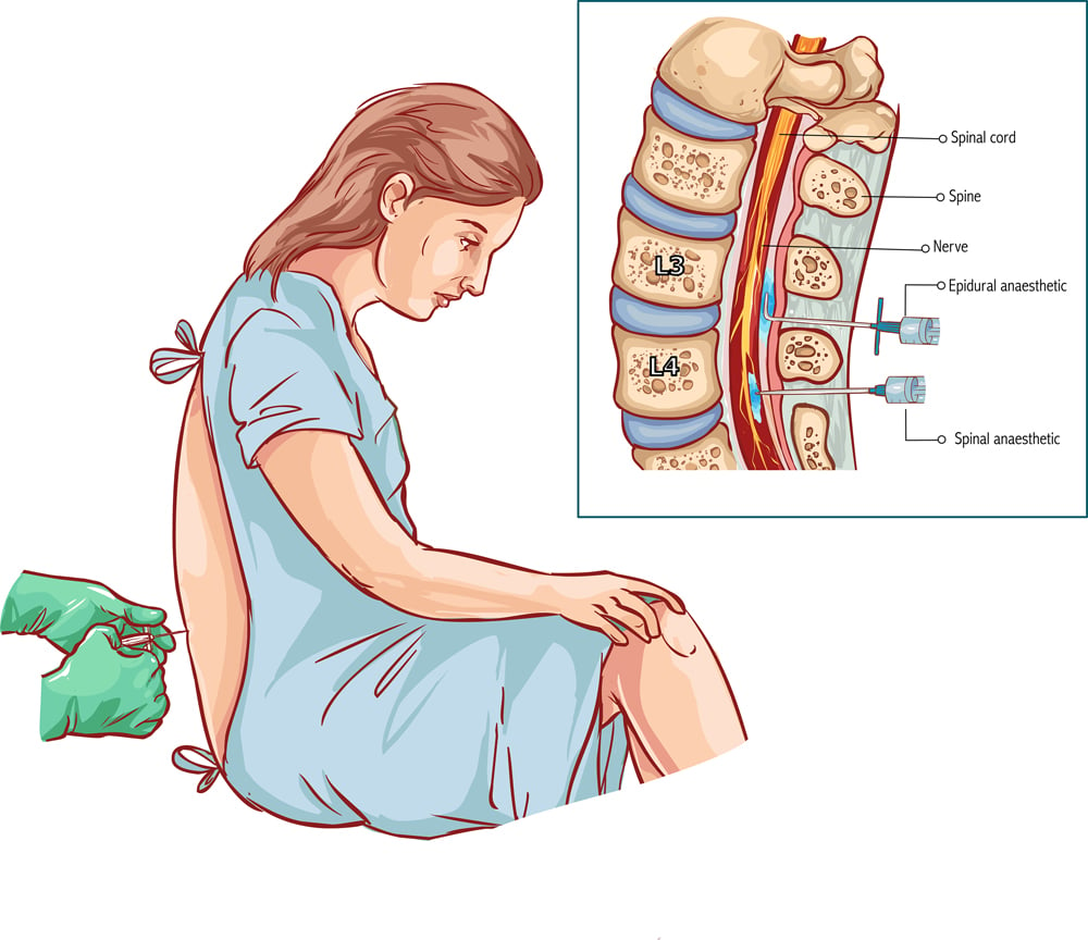 Epidural Nerve Block Injection(corbac40)s