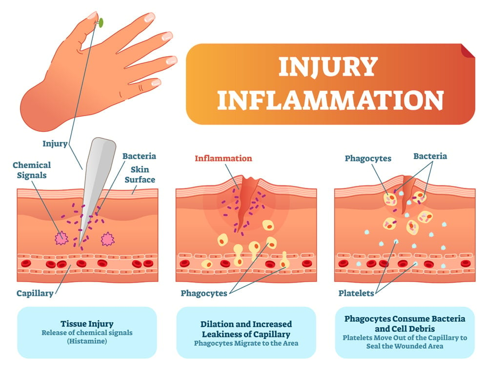 Esquema de ilustração vetorial de resposta biológica do corpo humano à inflamação de lesão