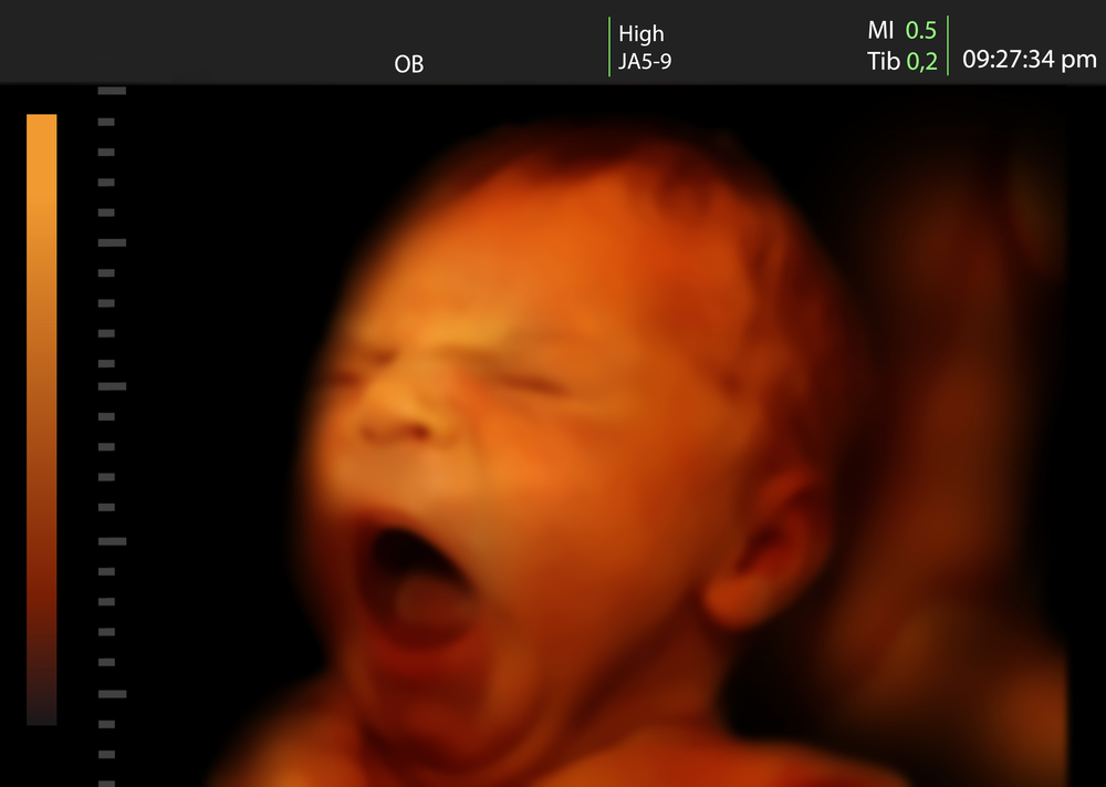 Imagem de um bebê recém-nascido bocejando como ultrassom 3D de um bebê no ventre da mãe (Valentina Razumova) s