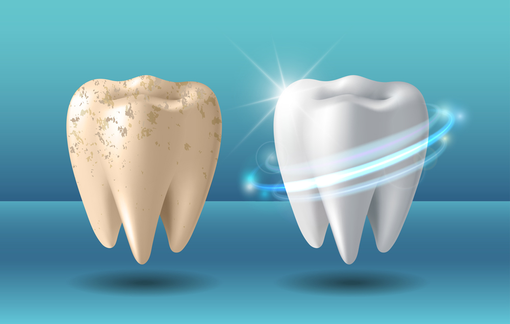 Comparison of clean and dirty tooth before and after whitening treatment(tassel78)s