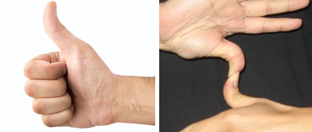 (No Hitchhiker's thumb (dominant) vs Hitchhiker's thumb (recessive)